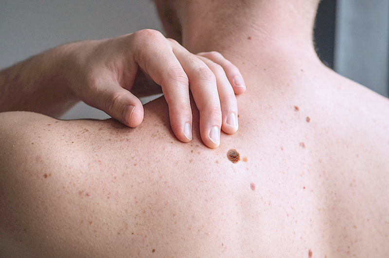 Aumento de casos de melanoma en Colombia, pone en alerta - El Pereirano