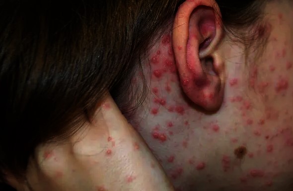 Se levanta el aislamiento en La 40 tras brote de varicela